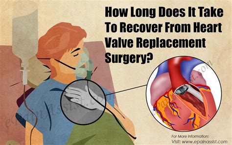 Regain Your Strength After A Valve Replacement - Finding Hope in the Recovery Process